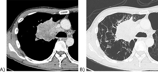 Chest computed tomography of the tumour. (A) Contrast-enhanced mediastinal window view. The tumour invaded the confluence of the superior vena cava and azygos vein. (B) Lung window view. The background lung was emphysematous.