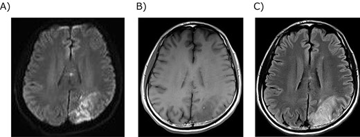 Magnetic resonance imaging of the brain infarction. (A) Diffusion-weighted image showed strong signals in the left parietal lobe. (B) T1-weighted image showed a low signal in the infarction. (C) T2-weighted image showed a high signal in the infarction.