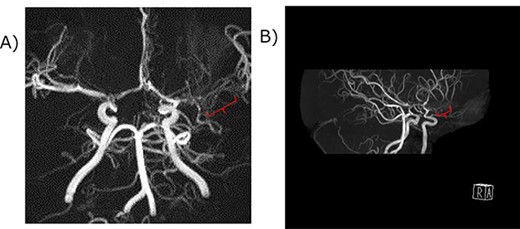 Magnetic resonance angiography of the middle cerebral artery. (A) A coronal view. (B) A Right anterior-lateral view. The red curly bracket indicates the immature M1 lesion of the middle cerebral artery. The distal part of the left middle cerebral artery was not atrophic, suggesting Ap/twig-like MCA.