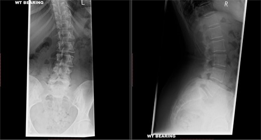 Preoperative X-ray of the lumbar spine performed in December 2015, confirming small idiopathic scoliosis in the lumbar spine.