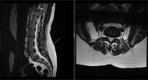 Preoperative MRI of the lumbar spine performed in December 2016. The MRI shows no neurological compression.