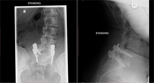 Postoperative X-ray of the lumbar spine performed in January 2017, showing the implants in place.