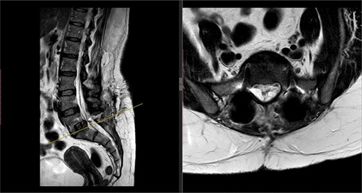 Postoperative MRI of the lumbar spine performed in January 2017. Interference from the metallic pedicular screws limited the scans clarity.