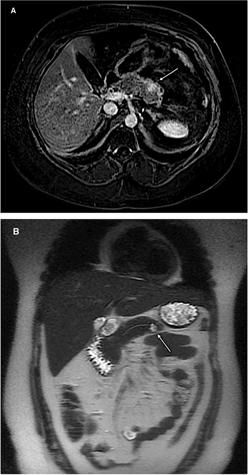 Magnetic resonance imaging of the abdomen (A: axial section, B: coronal section) showing a 1 cm lesion in the remnant pancreatic body.