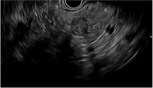 Endoscopic ultrasound showing a 13 × 10 mm solid lesion in the pancreatic remnant.