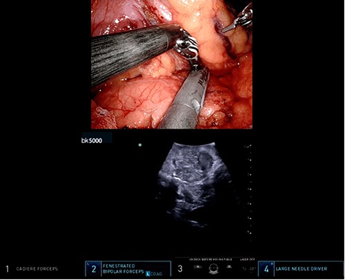 Intraoperative ultrasound revealing a 2 cm lesion in the pancreatic stump.