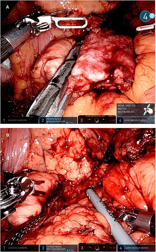 Intraoperative picture showing the pancreatic resection with a linear stapler (A) and the pancreatic stump with the stapler reinforcements in the resection line (B).