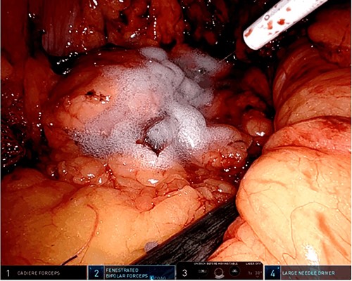 Fibrin glue applied on the section line.