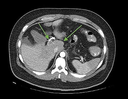 Axial cut. In the arrows, lack of opacification of the portal vein with its hyperdense walls, inferior vena cava, lack of splenic opacity.