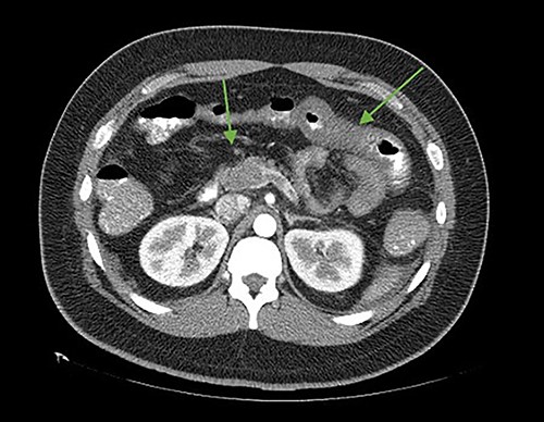 Axial cut. In the arrows, there is a lack of splenomesenteric opacification towards the posterior part of the pancreas and striation of the adjacent peripancreatic fat. Edematous intestinal walls in the jejunum, free fluid in the left paracolic gutter.