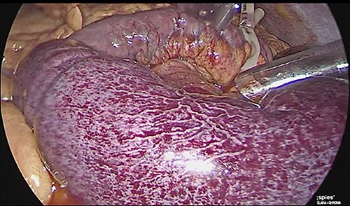 Laparoscopic view of intestinal thrombosis 200 cm at the level of the proximal jejunum, 50 cm from the ligament of Treitz.