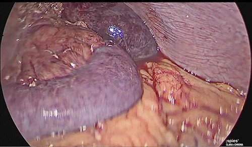 Laparoscopic view of intestinal thrombosis and free fluid in the cavity.