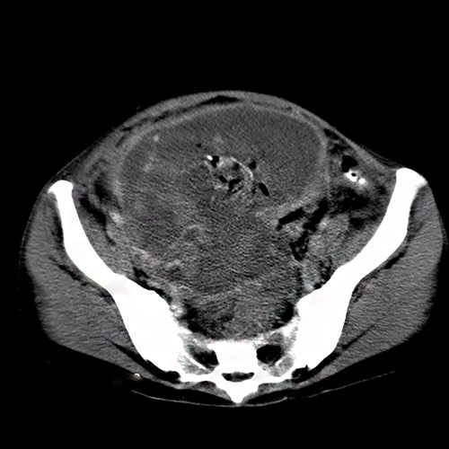 A heterogenic mass outside the uterus measuring 11 × 8 cm and containing blood clots and placental tissues.
