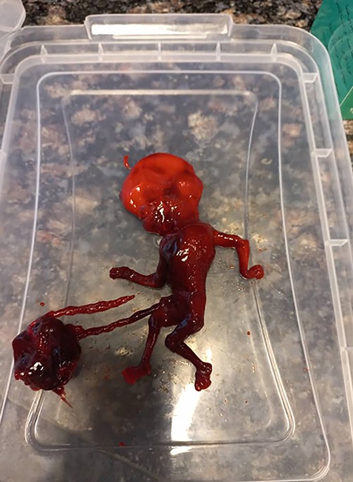 Unviable fetus measures 1.8 cm and corresponds to ~9 weeks of gestation.
