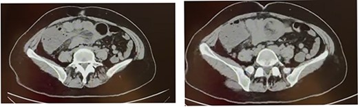Computed tomography scan shows colo-colonic invagination with the ‘target sign’ or ‘doughnut sing’.