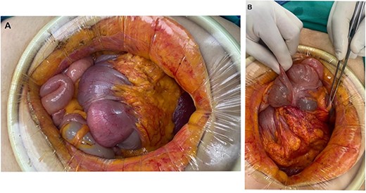 (A) The presence of an invaginating mass in the colon. (B) Colo-colonic intussusception involving the ascending colon, hepatic flexure and transverse colon.