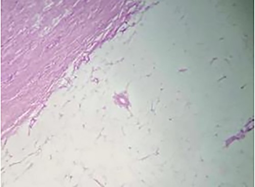 Histopathology results showing an expansive growth pattern, with invasion of the muscularis propria and serosa and extension towards the pericolonic adipose tissue. Immunohistochemical results were negative for MDM2 and Ki67.