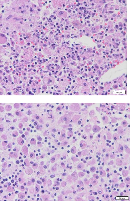 Diffuse proliferation of histiocytes with foreign body giant cell granuloma, Hematoxylin and Eosin H&E, 40x high power filed.