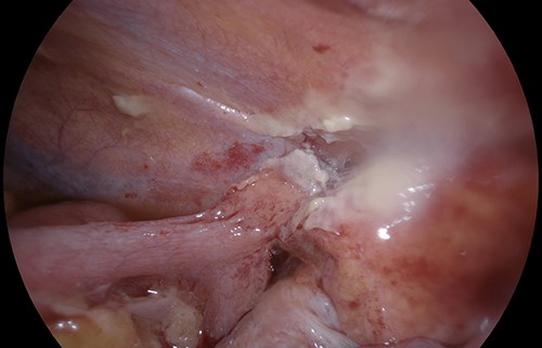 Small bowel obstruction transition point between terminal ileum, caecum and area of previously applied Floseal on abdominal wall.
