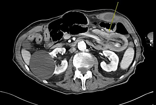 CT abdomen and pelvis revealing telescoping of J-tube (yellow arrow).