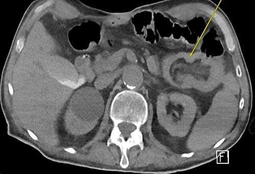 Repeat CTAP s/p JT removal revealed persistent J–J intussusception (yellow arrow).