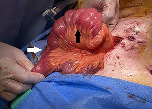 Intraoperative findings of jejunojejunal intussusception with distal collapsed bowel (white arrow) and proximal dilated bowel (black arrow).