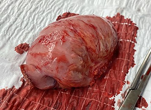 Segment of jejunum lead point excised.