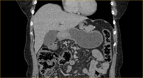 Portal phase coronal section image on CT showing excluded stomach distention with parietal thickening of the pylorus and antrum (arrow).