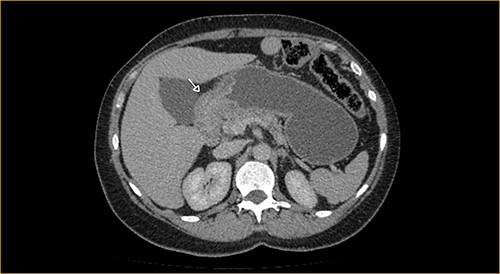 Portal phase transversal section image on CT showing excluded stomach distention with parietal thickening of the pylorus and antrum (arrow).