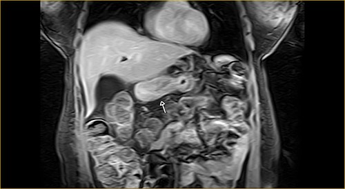 Coronal section on contrast magnetic resonance showing excluded stomach distention with parietal thickening of the pylorus and antrum (arrow).