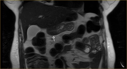 Transversal section on T2-weighted magnetic resonance showing excluded stomach distention with parietal thickening of the pylorus and antrum (arrow).