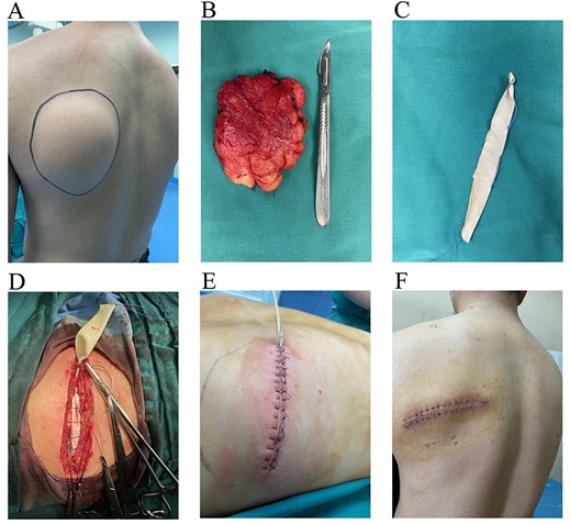 (A) A giant mass in the left scapular region. (B) A lipoma with a size of about 10.0 cm × 8.7 cm × 1.6 cm. (C) A self-made rubber drainage strip. (D) Placing a self-made rubber drainage strip before closing the incision. (E) Interrupted vertical mattress valgus suture was completed. (F) The sutures were removed 12 days postoperatively and the incision healed well.