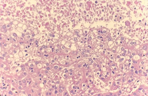 Microscopic examination reveals compact tumor nests and sheets of cells with clear cytoplasm and distinct membrane. HE stain 40x.