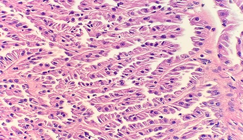 Microscopic examination reveals small cuboidal cells arranged in a single layer on papillary cores. HE stain 40x.