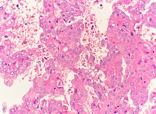 Microscopic examination reveals pseudostratified tumor cells with papillary architecture, abundant eosinophilic, atypical nuclei and prominent nucleoli. HE stain 40x.