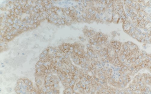 Immunohistochemical stain reveals that tumor cells are positive for alpha-methyacyl-CoA racemase. IHC stain 40x.