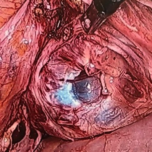 Laparoscopic view of opened vault.