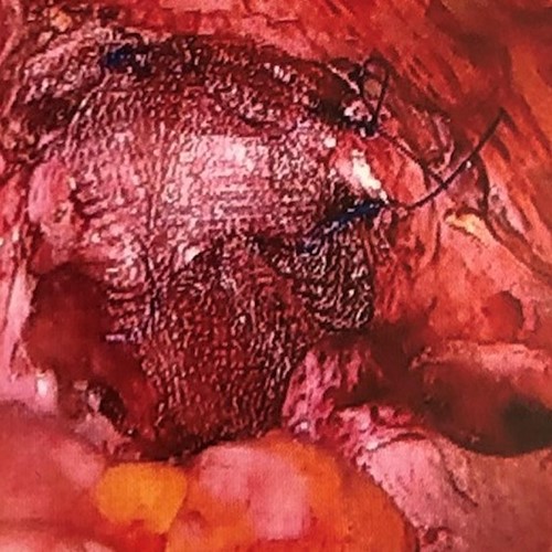 Vault covered with the mesh.