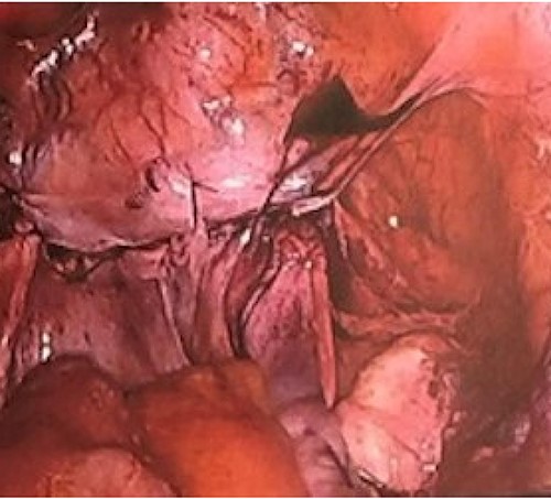 Completed procedure.