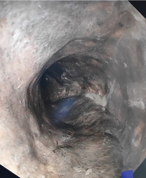 Upper gastrointestinal endoscopy image demonstrating oesophageal necrosis.