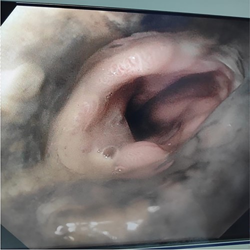 Upper gastrointestinal endoscopy image demonstrating sparing of the gastro-oesophageal junction.