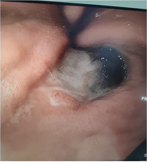 Upper gastrointestinal endoscopy image demonstrating gastric fundus necrosis.