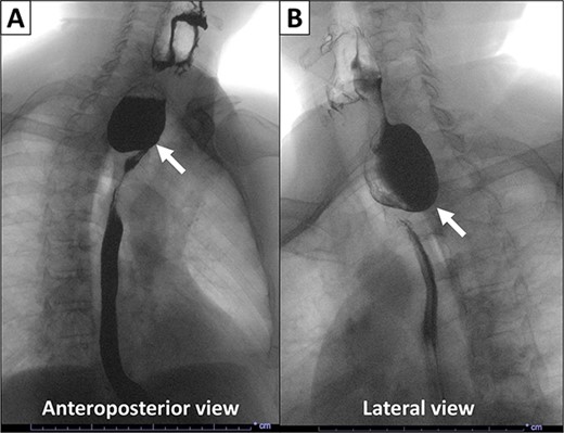 X-ray esophagogram performed in 2015. Esophagogram with barium suspension showed a 4 × 5 cm Zenker’s diverticulum with a 1.7 cm wide diverticular neck.