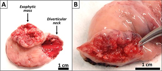 Gross images of the diverticulectomy specimen. (A) Exophytic and ulcerated mass identified within the Zenker’s diverticulum. (B) Sectioning across the mass showed a white cut surface involving the full thickness of the esophageal wall and grossly abutting the serosal surface.