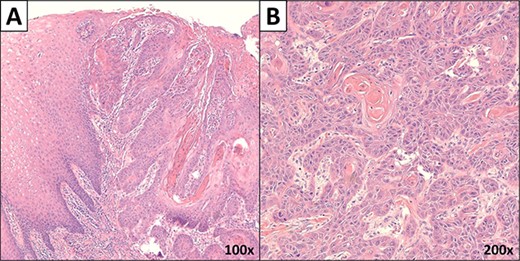 Microscopic images of the mass. (A) Low power microscopic image showing moderately differentiated SCC invading the submucosa (×100 magnification). (B) High power image of the carcinoma (×200 magnification).