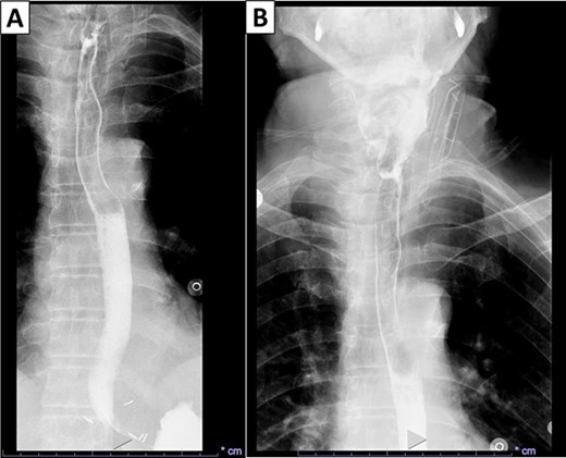 X-ray esophagogram performed postoperatively. No postoperative leak and no residual ZD were seen.