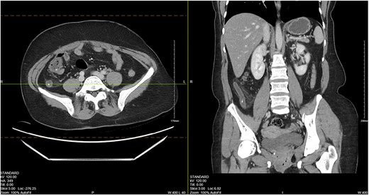 CT abdomen/pelvis showing a dilated appendix with wall thickening, periappendiceal induration and appendicoliths.