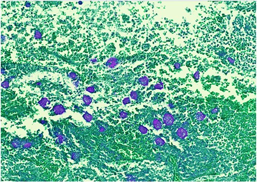 PAS stain—parasites are positive.