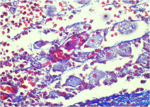 Trichrome stain—parasites are positive; erythrophagocytosis supporting Entamoeba histolytica.