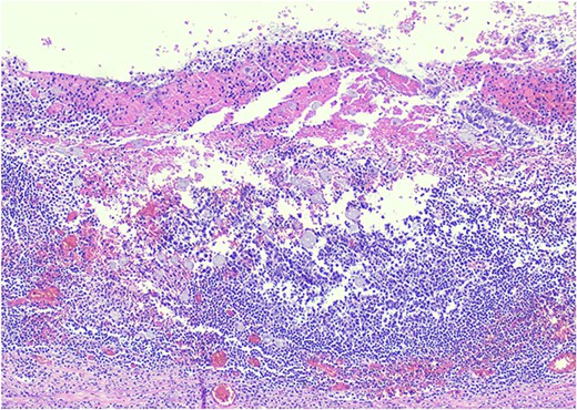 H&E 200X—unicellular parasites within submucosal tissue with inflammation.